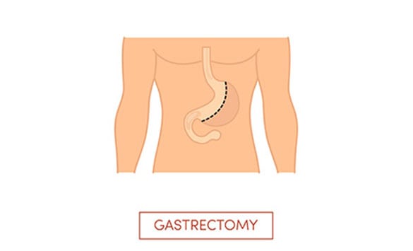 Cost-for-Gastric-Sleeve-The-Sleeve-Center