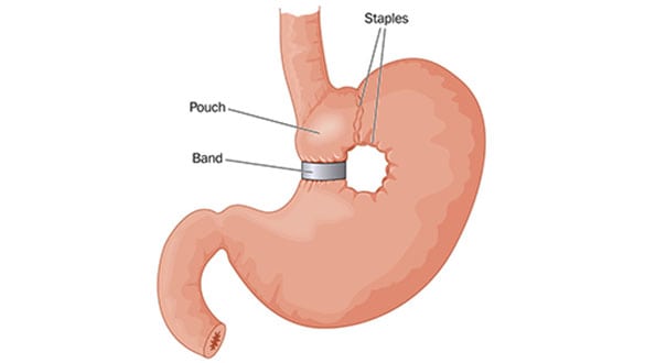 Gastric-Band-Surgery-The-Sleeve-Center