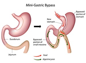 Gastric-Bypass-The-Sleeve-Center-3