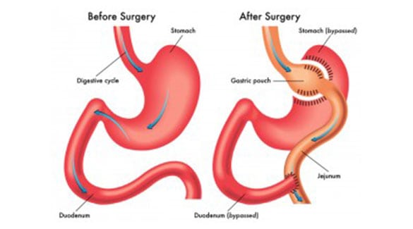 Gastric-Surgery-The-Sleeve-Center