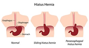 Hiatal-Hernia-Repair-The-Sleeve-Center-2