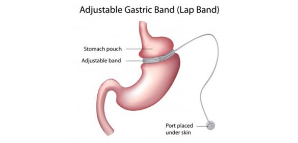 Lap-Band-Revision-The-Sleeve-Center