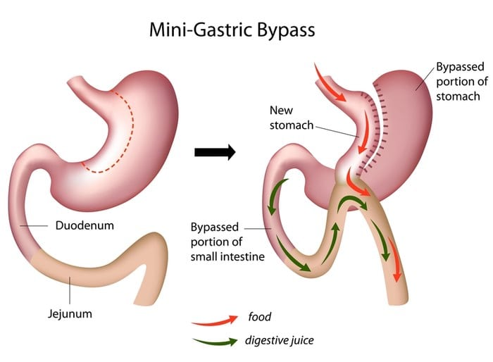 Revision Bariatric Surgery - Sleeve Center