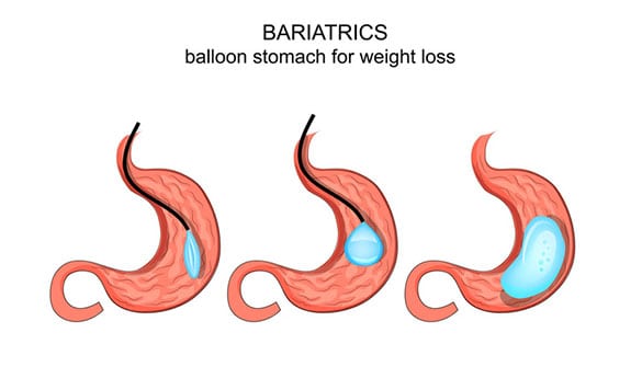 Revision-Bariatric-Surgery-The-Sleeve-Center
