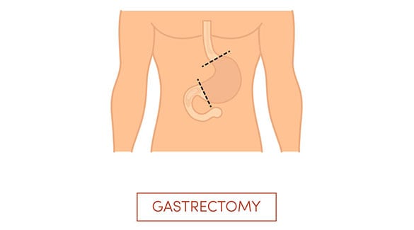 VSG-Surgery-The-Sleeve-Center