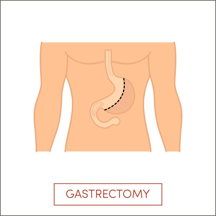 Vertical Sleeve Gastrectomy - The Sleeve Center 2