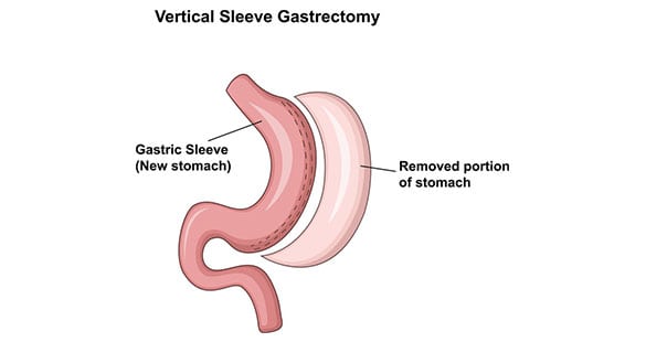 Vertical-Sleeve-Gastrectomy-The-Sleeve-Center