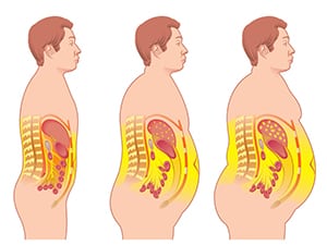 Weight-Loss-Surgery-The-Sleeve-Center-3