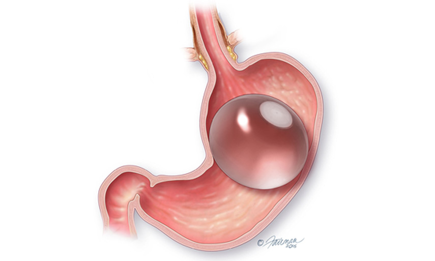Orbera-balloon-in-illustrated-stomach